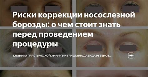 Проблема миграции филлера в носослезной борозде: влияние на организм