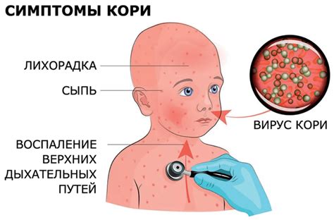Продолжительность заболевания ветрянкой взрослых и детей