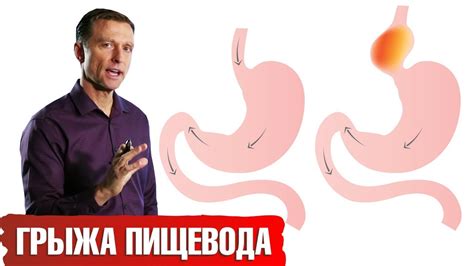 Противопоказания для массажа при грыже пищевода: когда следует воздержаться