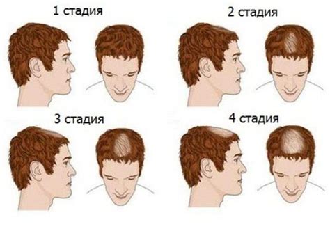 Профессиональное лечение облысения у мужчин
