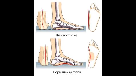 Профилактика и лечение плоскостопия