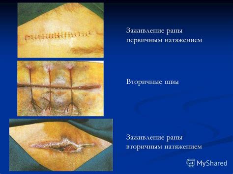 Процесс залечивания послеоперационной раны