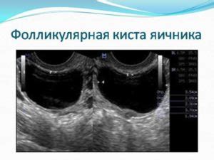 Различные методы ставки спирали при кисте яичника