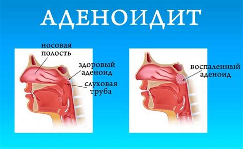 Различные подходы к удалению миндалин при повышенном АСЛО