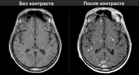 Распространение рака мозга