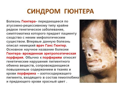 Редкие генетические синдромы и их связь с недостаточным количеством хромосом