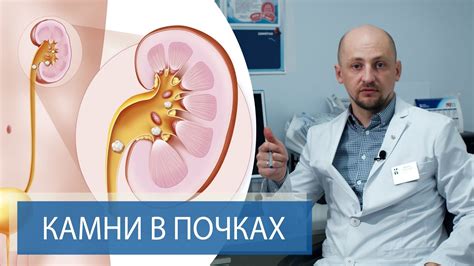 Рекомендации по использованию креатина при камнях в почках