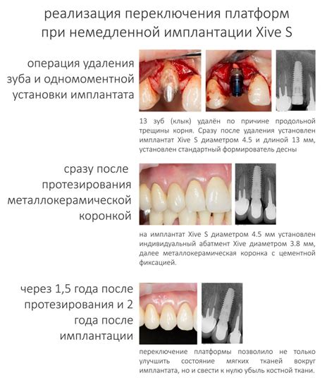Рекомендации по удалению металлических имплантатов