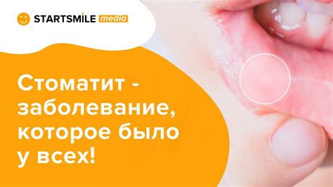 Рекомендации по целованию при стоматите на языке