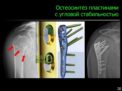 Роль металлоконструкции в остеосинтезе