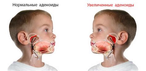 Симптомы, при которых удаляют аденоиды