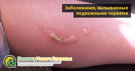 Симптомы блох под кожей у человека
