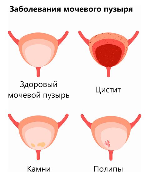 Симптомы выделений из уретры у женщин