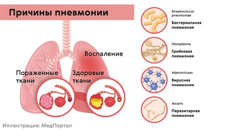 Симптомы и диагностика пневмонии