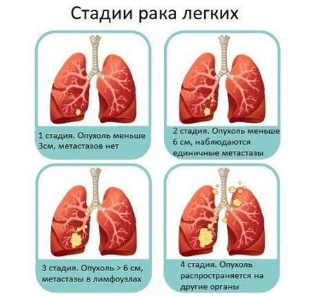 Симптомы метастазов на первой стадии