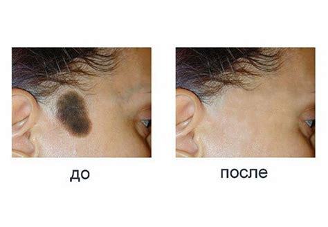 Способы удаления родимого пятна под глазом