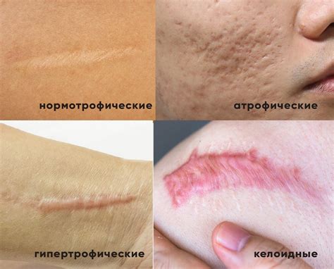 Типы шрамов и их влияние на накачку губ