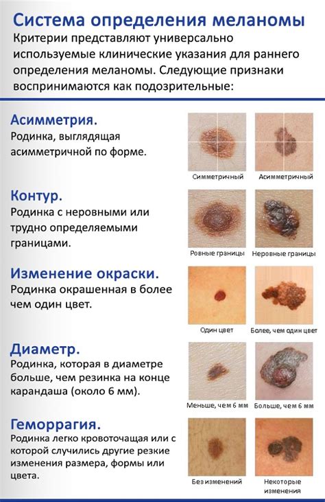 Угроза метастазов на первой стадии
