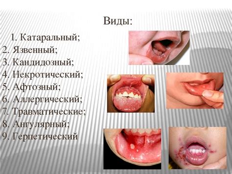 Узнайте, можно ли целоваться при стоматите на языке
