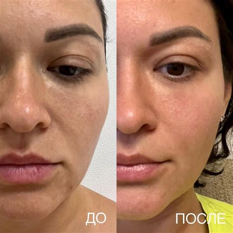 Упражнения для снижения жирового слоя в области лица