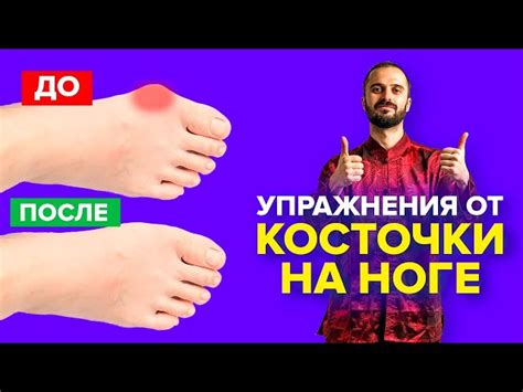 Устранение косточки на ноге дома