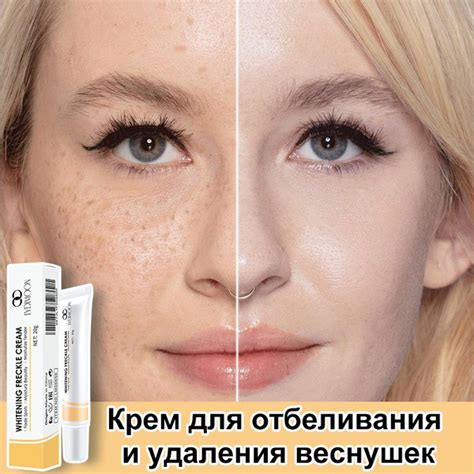 Устранение пигментации и веснушек