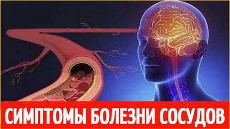 Факторы, ухудшающие состояние головных сосудов