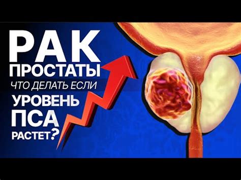Факторы риска и профилактика рака простаты