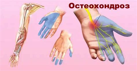 Физиологические механизмы головнойболи и онемения в левой руке
