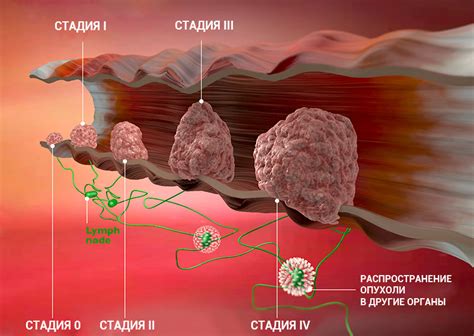 Что такое первая стадия рака