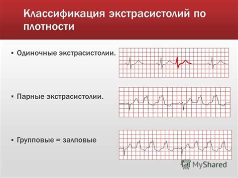 Экстрасистолия: определение и причины