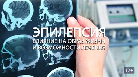 Эпилепсия в вузе: возможности и решения