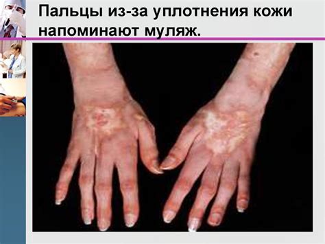 Эффективность массажа при системных заболеваниях кожи