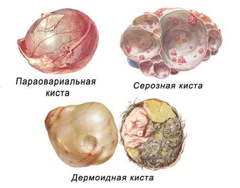 Эффективность применения Джеса при кисте яичника: исследования и отзывы