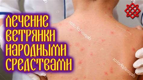 Эффективные методы снижения температуры при ветрянке у взрослых