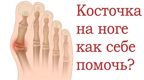 Эффективные способы избавления от косточки на ноге без хирургического вмешательства