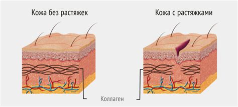 Эффективные способы избавления от растяжек на животе