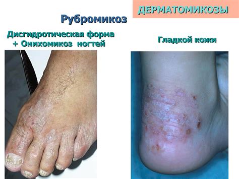  Влияние грибов на грибковые заболевания 